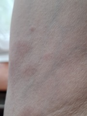 Surgery tomorrow- RASH with photos