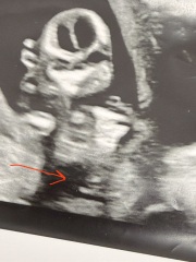 Nub theory? 12 weeks 4 days