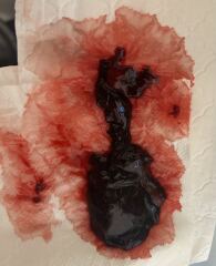Does this look like a miscarriage im 10 weeks pregnant?