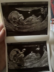 Pregnancy