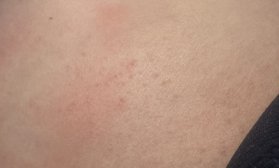 Can anyone help me identify this rash?