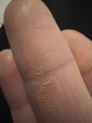 Is this a wart or dry skin??