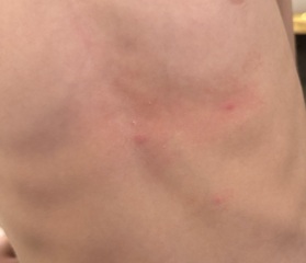 Is this chickenpox?