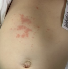 Rash on tummy
