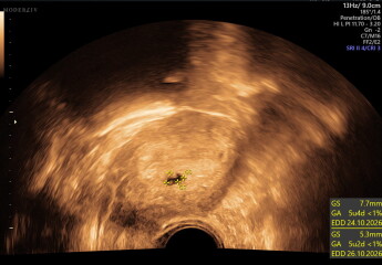 scan at 5 weeks 3 days, no heartbeats but possible twins (picture)