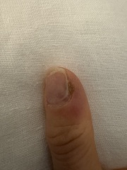 Bacterial Infection from manicure WWYD?