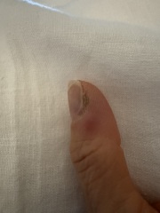 Bacterial Infection from manicure WWYD?