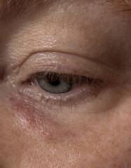 Shingles on forehead