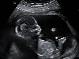 Boy or girl guesses?