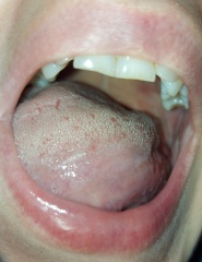 Sorry TMI, gross photos, but is this oral thrush or something else?