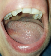Sorry TMI, gross photos, but is this oral thrush or something else?