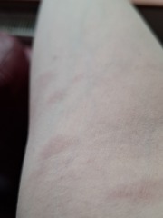 Surgery tomorrow- RASH with photos