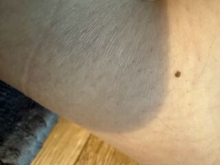 Black freckle/mole