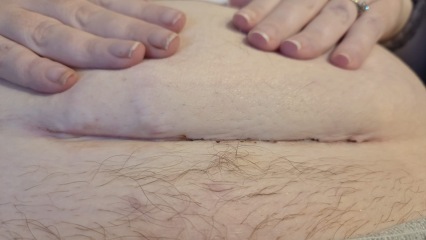 C section wound infection?