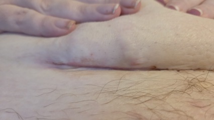 C section wound infection?