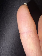 Is this a wart or dry skin??