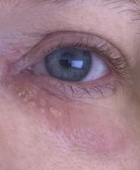 Shingles on forehead