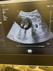 16 week scan, is this definetly a girl?!