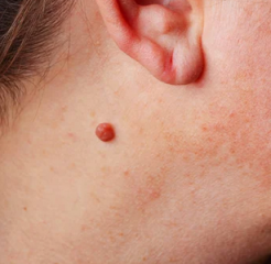 Has anyone had a facial mole removed?