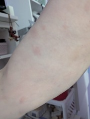 Surgery tomorrow- RASH with photos