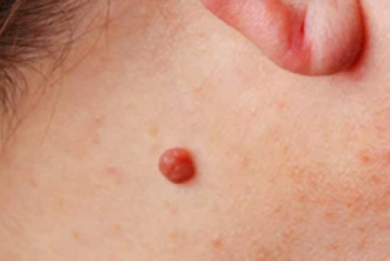 Has anyone had a facial mole removed?