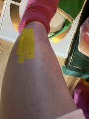 Would you say this is muscle or lymphoedema