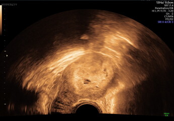 scan at 5 weeks 3 days, no heartbeats but possible twins (picture)