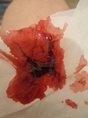 Is this a miscarriage?