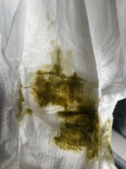 CMPA poo pic advice pleeeeaase!