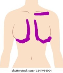 Is pain  in this location costochondritis
