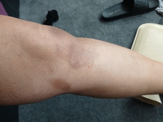 2nd degree burns from boiling water