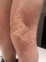 Photos - 5 year old rash that won’t heal