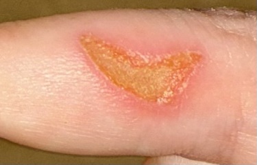 Any advice on this gross finger wound?