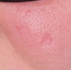 Has anyone had a facial mole removed?