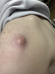 Infected cyst