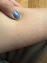 Black freckle/mole