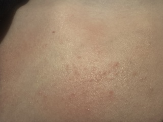 Can anyone help me identify this rash?