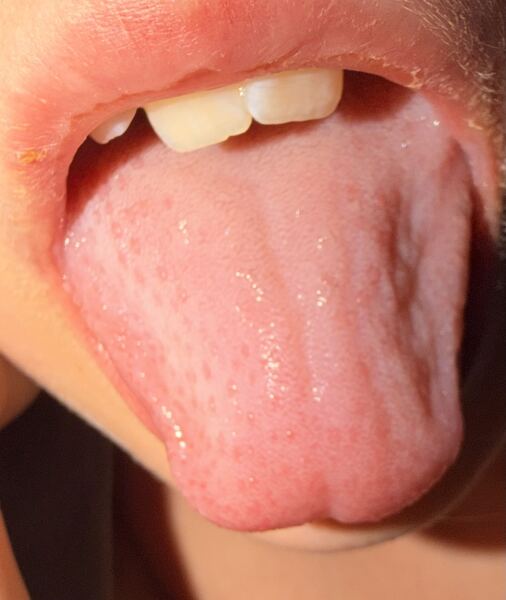 Is this strawberry tongue?