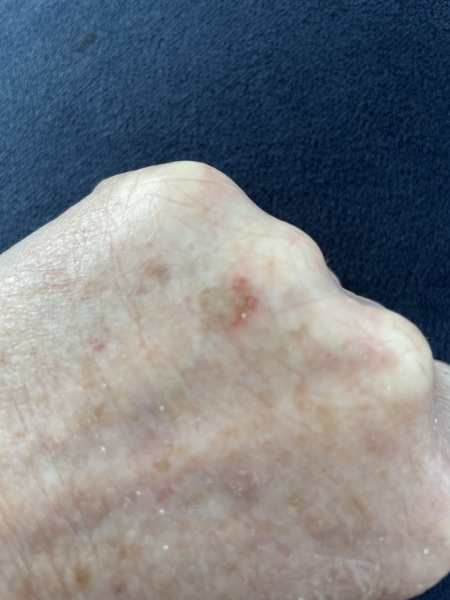 TW melanoma - with pic