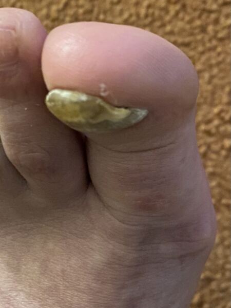 Trigger warning thick toenails