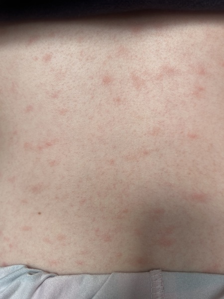 Rash - not meningitis