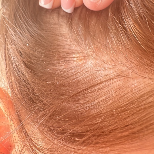 Dry flakey scalp