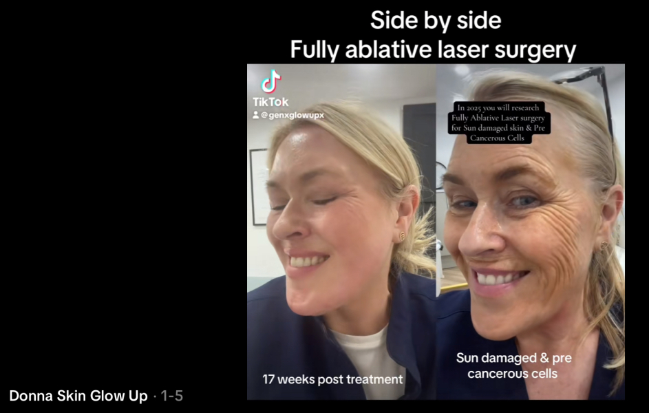 Deep plane face lift - advice from those that have had on recovery and result success stories