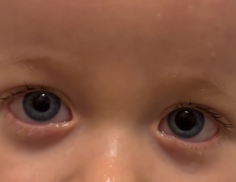 13 month old has slightly different pupil sizes, not sure what to do
