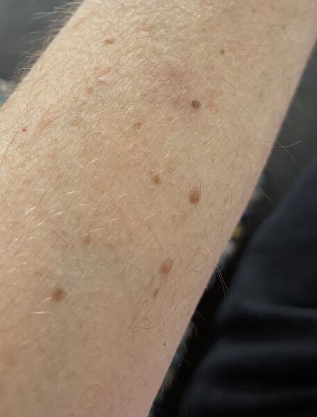 How many moles do you have on your body? I have over 100.