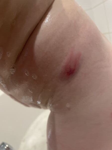 Dog bite or scratch?