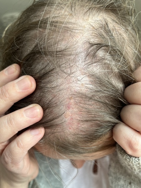 What is this on my scalp?