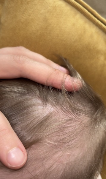 Baby has extremely dry scalp , what to use ?