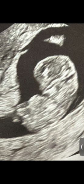 Miscarriage? Heavy bleeding? 11 weeks 4 days