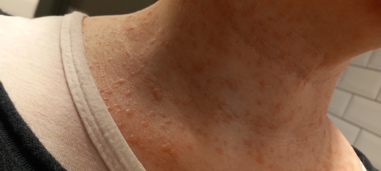 Hives accompanied by headache - anyone had this?